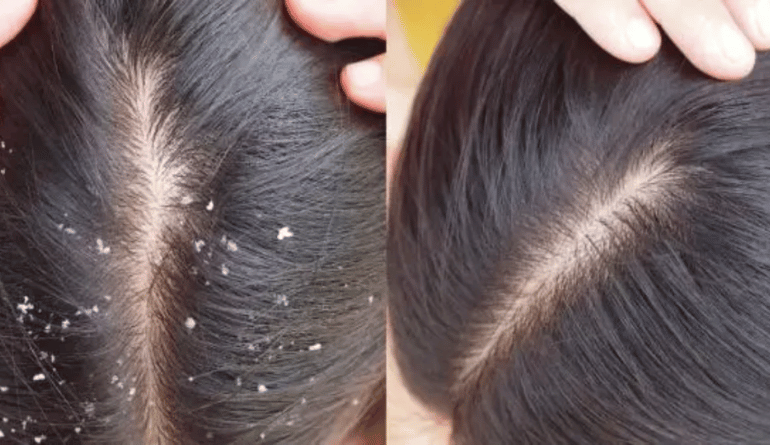 Best hair spa for dandruff